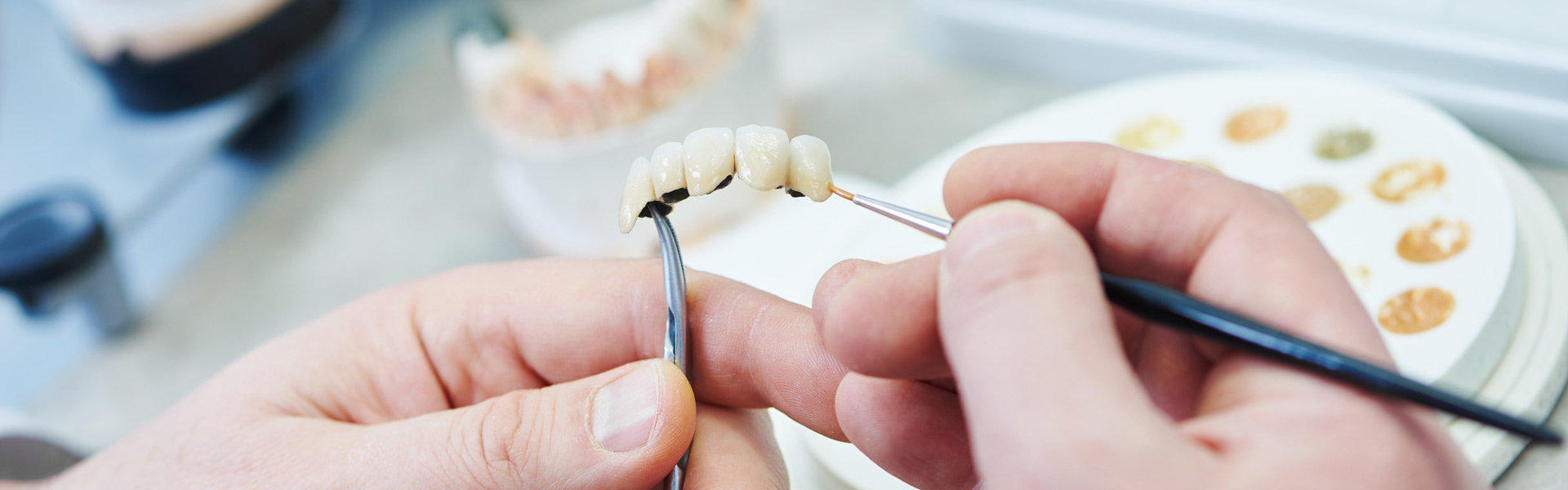 Anfertigung eines Zahnersatzes in der Zahnarztpraxis in Berlin-Wilmersdorf 